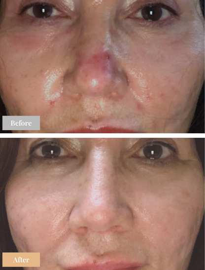 Omnilux Contour Face