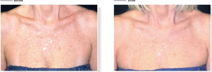 Omnilux Contour Neck & Décolleté