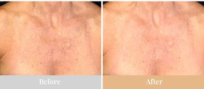 Omnilux Contour Neck & Décolleté